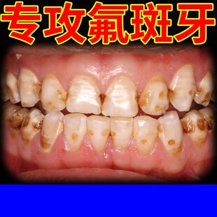 氟斑牙专用牙膏牙黑渍抽烟喝咖啡牙黄稀盐酸牙神器