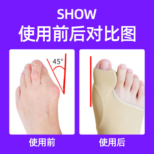 脚趾矫正器拇指外翻分离器女保护趾头纠正带脚型护理脚骨分趾器