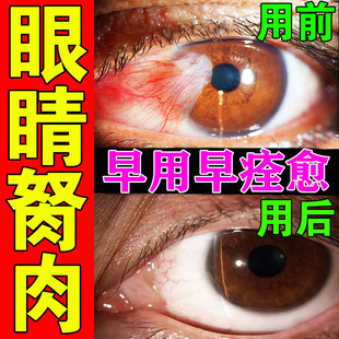 200%消 去除眼睛胬肉翼状滴眼M液眼干眼红异物感眼水 眼睛胬肉
