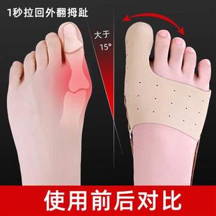 拇指外翻矫正器大母脚趾头内翻矫形纠正带男女士可以分趾器可穿鞋