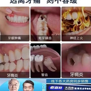 推荐 牙疼牙痛止疼药速效喷剂杀蛀牙虫牙牙神经疼智齿牙龈肿克星专